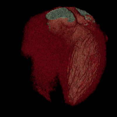 An image of the human heart with stents typically used to treat narrow or weak arteries. Image Credits: GE Healthcare