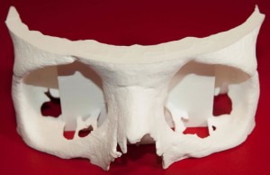 3D Physical Skull Model (Photo courtesy of Mcor Technologies Ltd.)