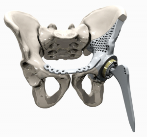 This artificial hip together with the integrated joint replaces all of the bone affected by cancer. The illness of the 15-year-old boy spread quickly, so the implant had to be available as fast as possible (courtesy of Instrumentaria).