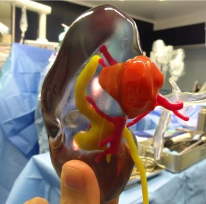Using Stratasys' transparent VeroClear material enables Dr Bernhard to see inside the kidney and estimate the specific location and depth at which the tumor resides. (Photo: Stratasys)
