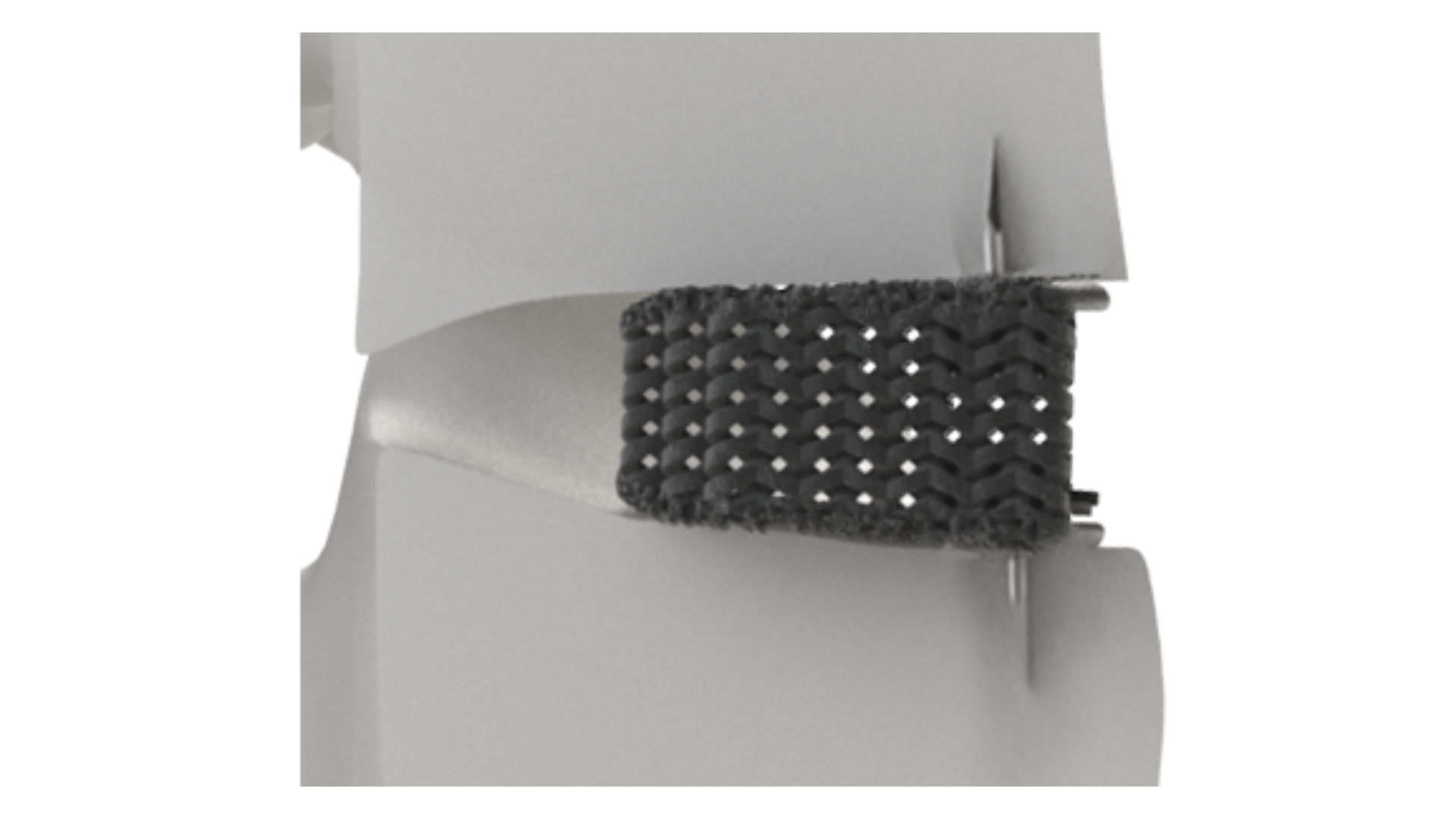 Nexus Spine announced the beta launch of Stable-C™, 3D printed cervical interbody fusion implants featuring integrated anchoring blades.